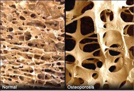 正常骨与骨质疏松骨的对比