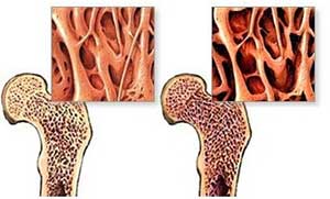 骨质疏松与正常骨的对比图