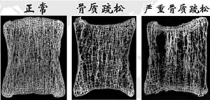 缺钙骨质疏松和正常骨对比