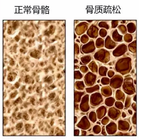 绿巨人视频app黄色官方下载检测仪生产厂家骨质疏松老年人疾病年轻人需要做绿巨人视频app黄色官方下载检测吗